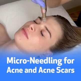 Micro-Needling for Acne and Acne Scars